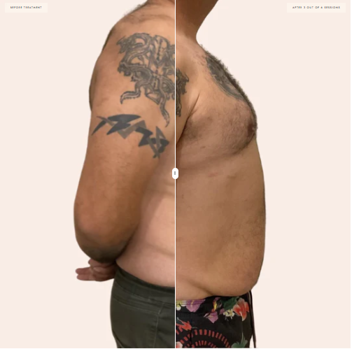 Brisbane Non-surgical BBL Brazilian Butt Lift