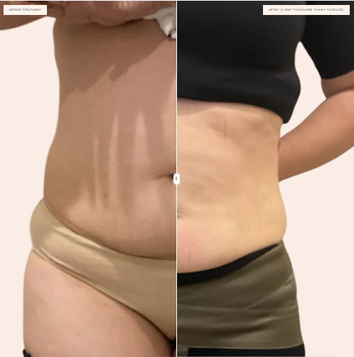 Brisbane Body contouring