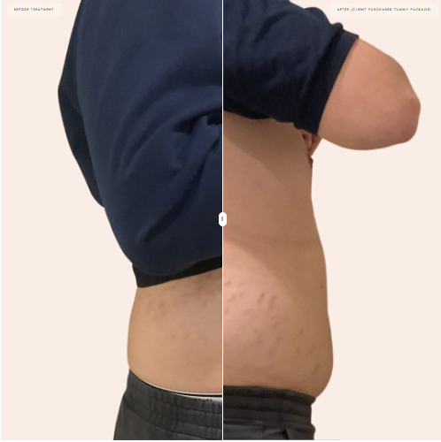 Brisbane Body contouring