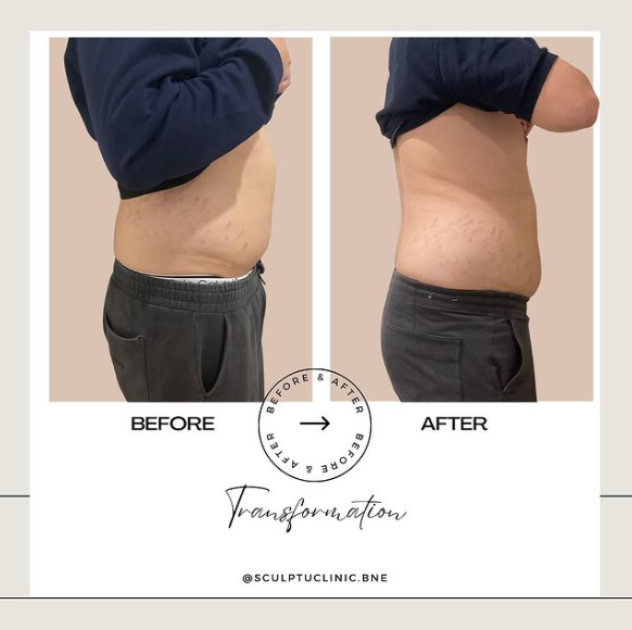 Brisbane Non-surgical BBL Brazilian Butt Lift