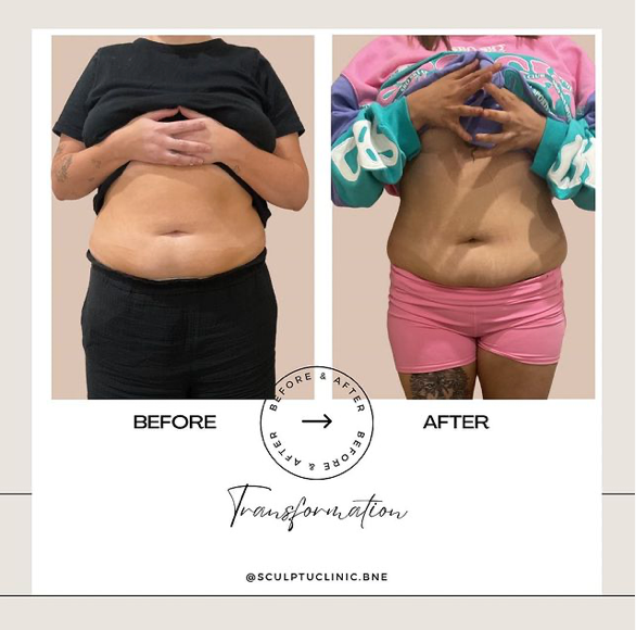 Brisbane Body contouring