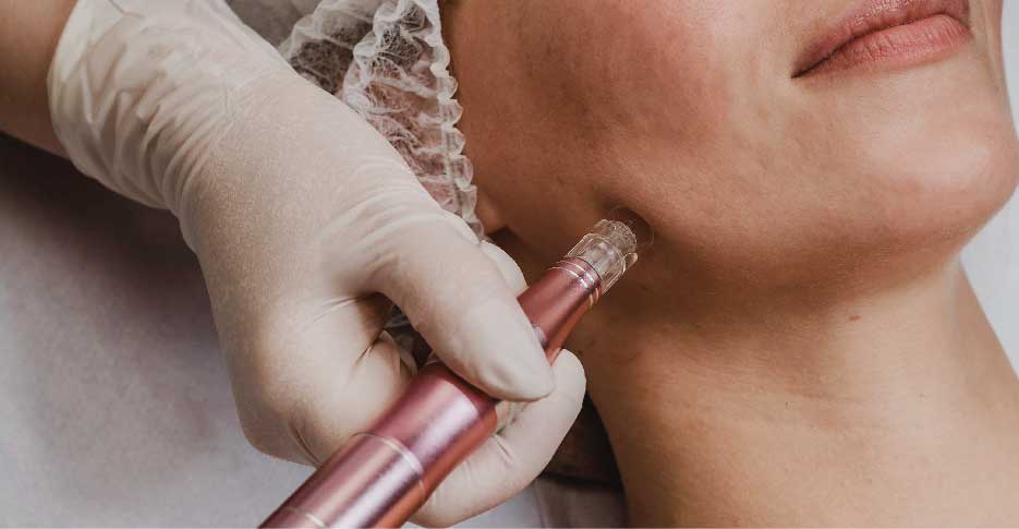 Brisbane Skin needling