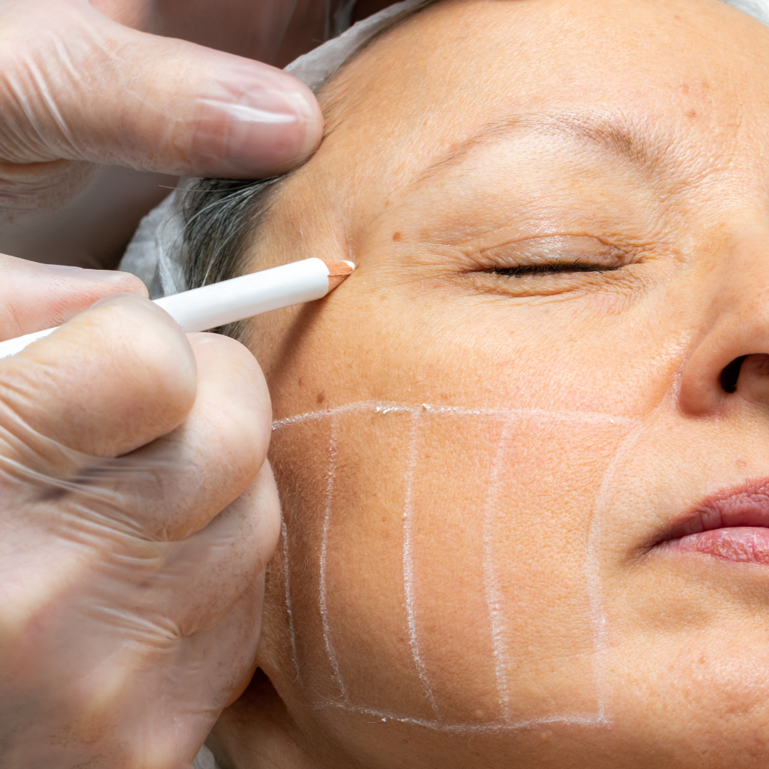 Brisbane Skin needling
